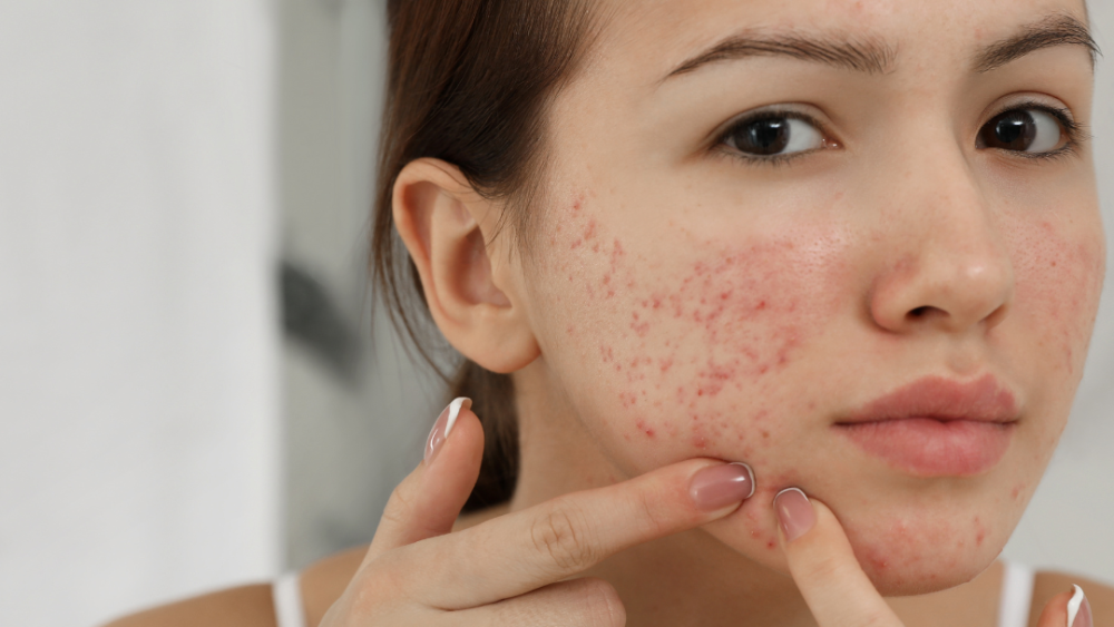 Diet and Acne: What You Need to Know