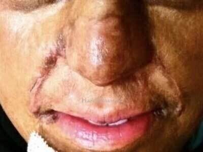 Medical Micropigmentation