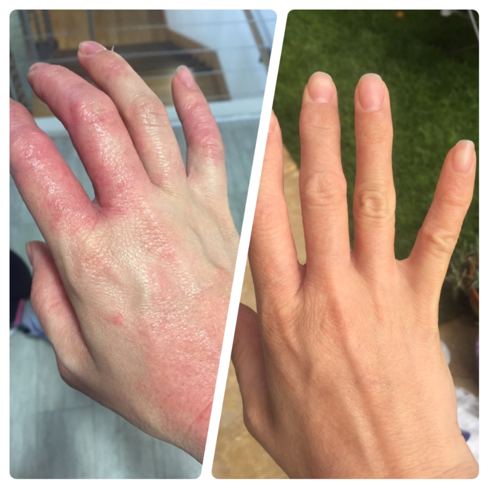 Eczema Myths Busted: Separating Fact from Fiction for Healthier Skin