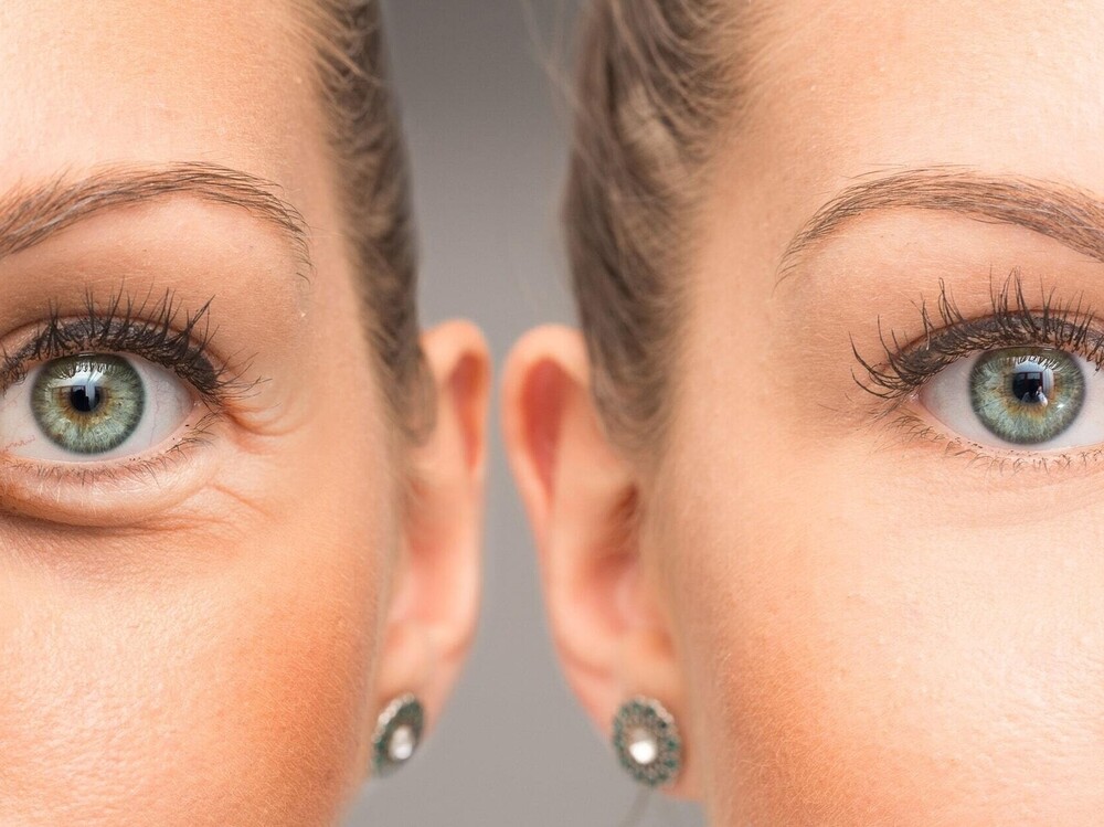 Blepharoplasty 