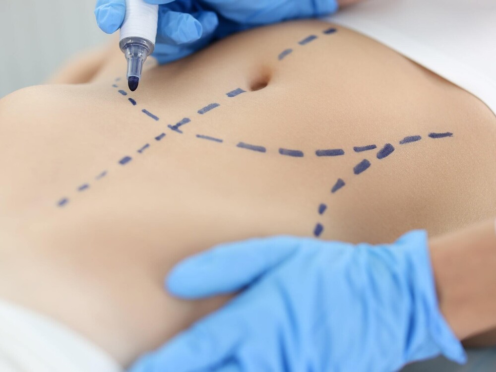 Abdominoplasty (Tummy tuck)