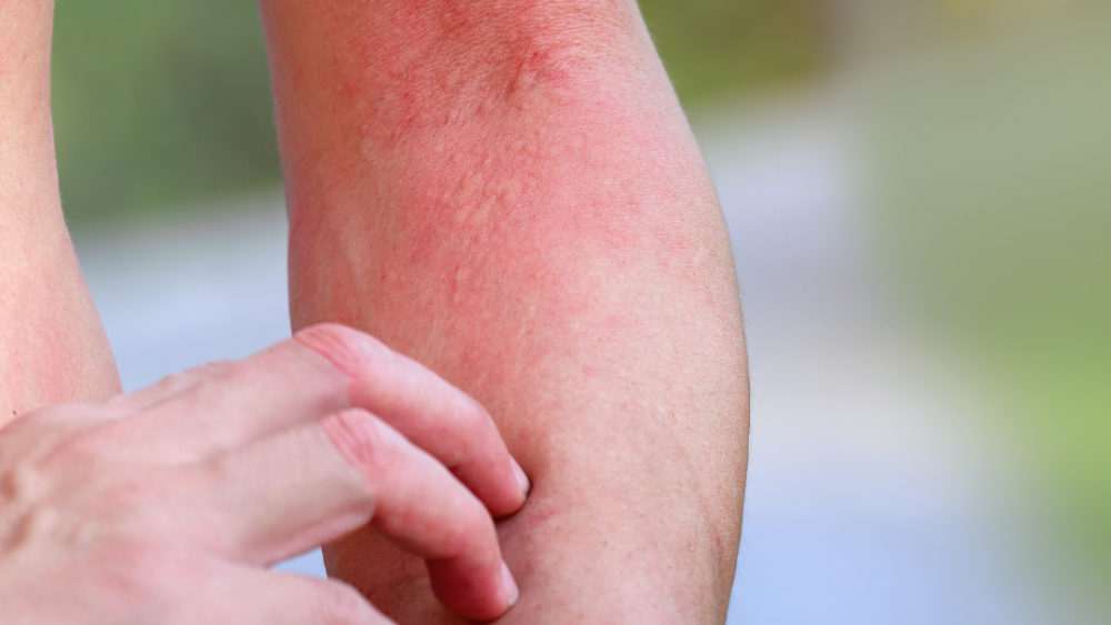 Understanding the Link Between Blood Sugar Dysregulation and Skin Flares