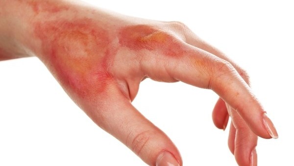 ஆலய கஞ்சிக் கிடாரத்துக்குள் விழுந்து சிறுவன் படுகாயம்