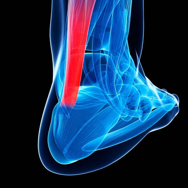 Achilles tendinopathy