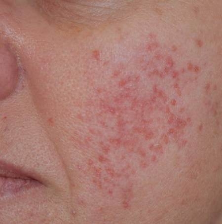 *Lets talk about Rosacea *