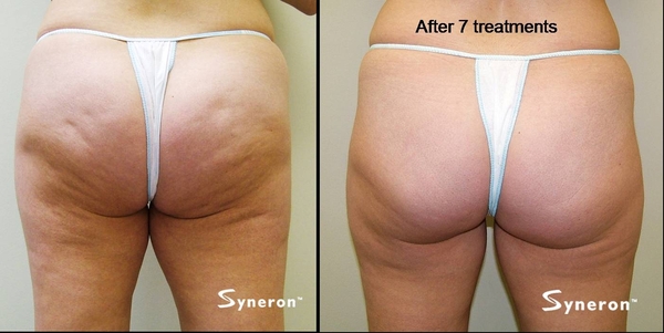*Bust Your Cellulite in time for Summer! *