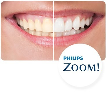Teeth Whitening,teeth Bleaching