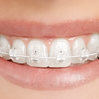Ceramic "tooth coloured" braces Barnet