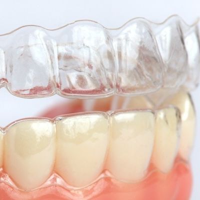 "Invisible" clear aligner brace Finchley