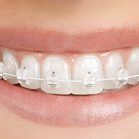 Invisible Orthodontics & Teeth Straightening at Eyes & Smiles Dental Clinic in  Friern Barnet North London N11, Teeth Straightening Treatment, Crooked Teeth Treatment, Overbite treatment, Protruding teeth treatment, goofy teeth treatment, teeth stick out treatment, crowded teeth treatment, receding gums treatment, space closure, gap closure, uneven teeth treatment, fang teeth treatment, wonky smile treatment, slanted teeth, metal braces, clear braces, white braces, adult braces, ceramic braces, removable braces, retainers,