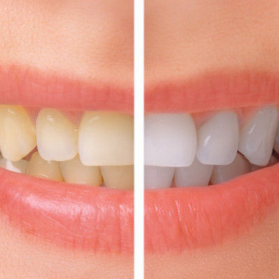 Teeth Whitening & Enlighten Smiles at At Eyes & Smiles Dental Clinic in Friern Barnet, North London N11, Whiter teeth, smoker stains, stain removal, laser whitening, b1 shade teeth, brighter teeth, teeth whitening sensitivity, oral health healer, essex smile, hollywood smile, safe whitening, home whitening, day whitening, night whitening, tray whitening, whitening gel, boutique whitening, white dental beauty, red wine stains, smoking stains, dark tooth, curry stains, white spots