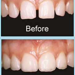 Transformational dental veneers to close up gaps between teeth in Barnet Eyes & Smiles Dental Clinic