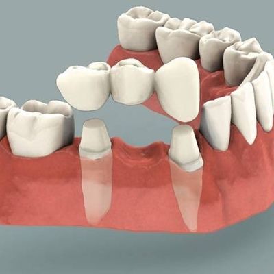 Dental bridges to replace missing teeth and gaps to restore you smile in Barnet Eyes & Smiles