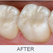 Mercury-free White Fillings in Southgate