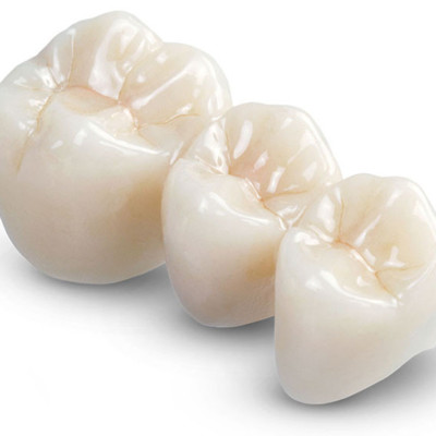 Bridges & Missing Teeth Replacements  At Eyes & Smiles Dental Clinic in Friern Barnet North London N11, Gaps, Maryland bridge, sticky bridge, resin bonded bridge, fixed bridge, ,