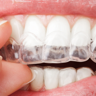 Home Teeth Whitening N11 Using Super-Fit Trays