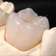 Successful natural looking and well fitting crowns to transform your teeth at Eyes & Smiles Dental Clinic Barnet