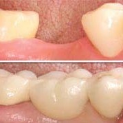 Permanent Dental bridges to improve chewing and replace missing back teeth in Southgate Eyes & Smiles Dental Clinic