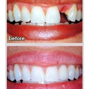 Natural and fixed dental bridges to replace missing front teeth in Finchley Eyes & Smiles Dental Clinic