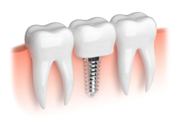 Dental Implants