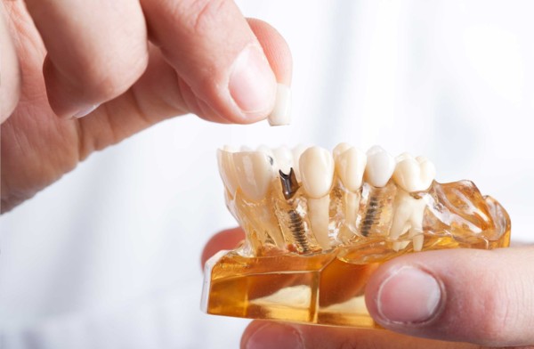 Dental Implants