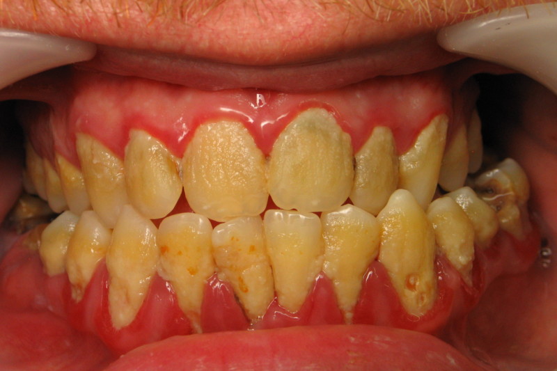 Periodontal Treatment