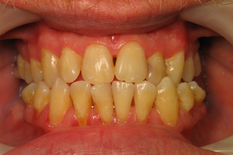 Periodontal Treatment
