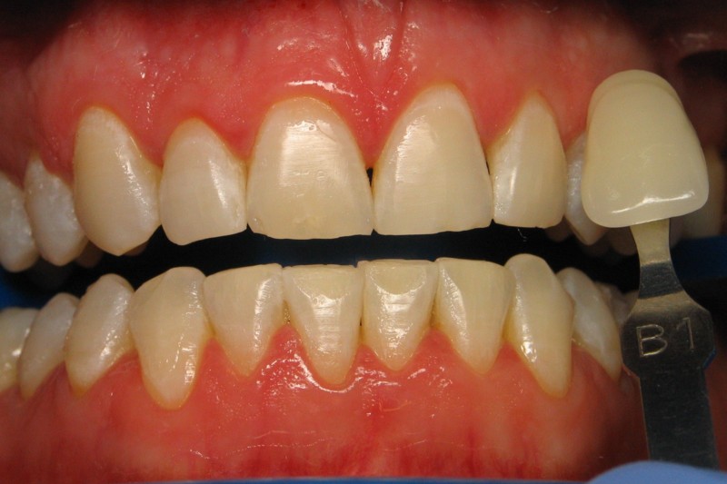 Teeth Whitening