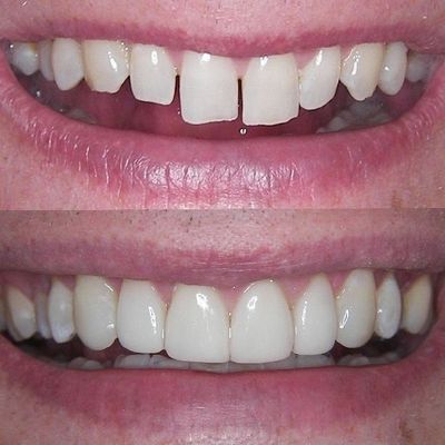 Dental Cosmetic Bonding and Gap Closing in Barnet