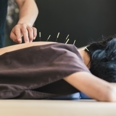Acupuncture for Fibromyalgia