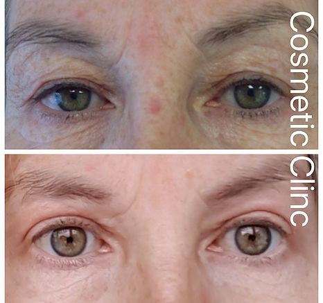 Botox Sheffield, Fillers Sheffield, Nurse Louise Beer