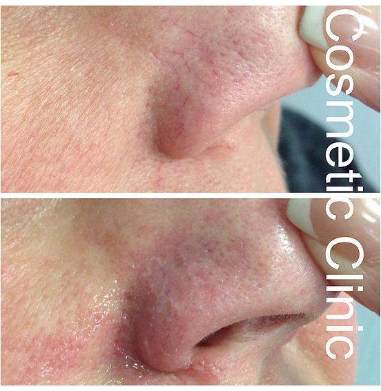 Botox Sheffield, Fillers Sheffield, Nurse Louise Beer