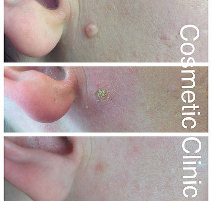 Botox Sheffield, Fillers Sheffield, Nurse Louise Beer