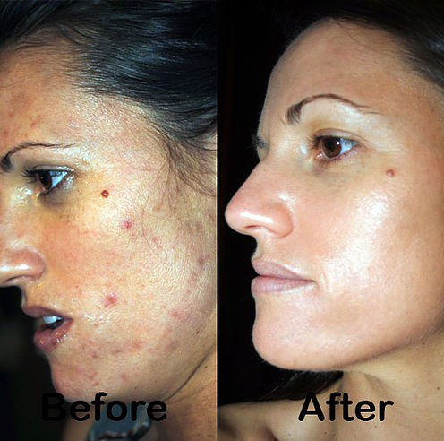 Botox Sheffield, Fillers Sheffield, Nurse Louise Beer