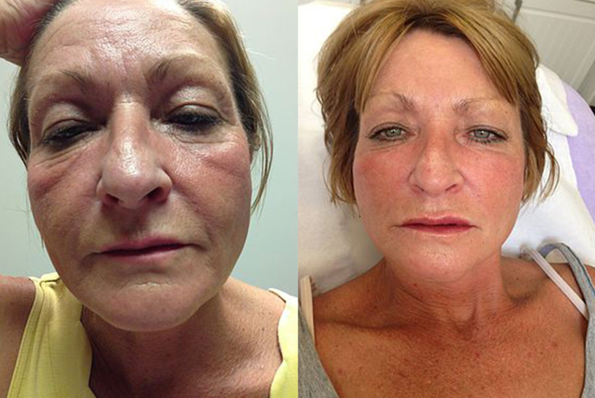 Botox Sheffield, Fillers Sheffield, Nurse Louise Beer