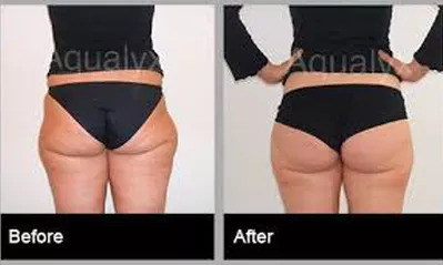 Botox Sheffield, Fillers Sheffield, Nurse Louise Beer