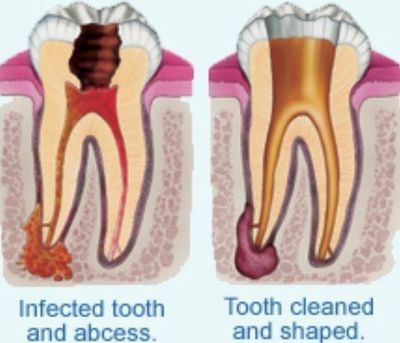 Emergency root canal treatment in North London