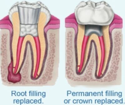 Painless Root Canal Treatment in North London N11