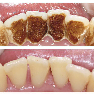 Teeth Stain Removal Barnet