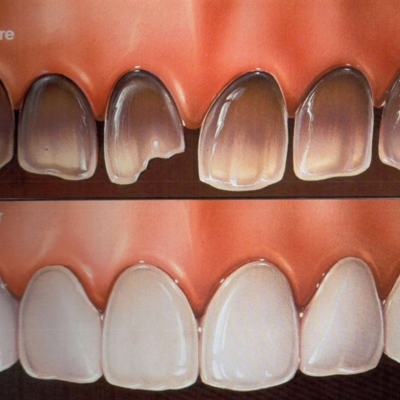 Dental veneers to hide discoloured and dark teeth in Southgate Eyes & Smiles Dental Clinic