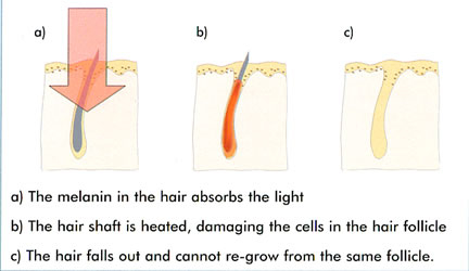 *The power of IPL for Hair Removal*