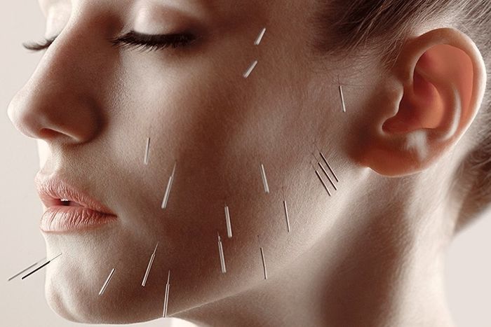 Natural Alternative to Botox Facial Acupuncture London , Cosmetic Acupuncture Chelsea, Facial Rejuvenation Acupuncture Bromley
