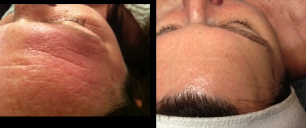 Harnessing the power of light therapy...Introducing Dermalux!